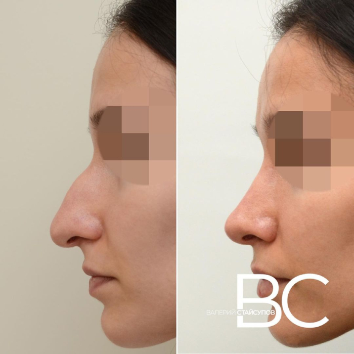 Пациентка хирурга Валерия Стайсупова до и после закрытой ринопластики носа с толстой кожей
