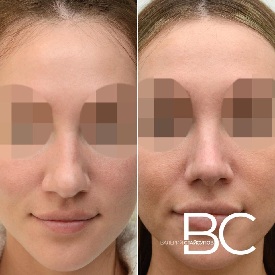 Пациентка Валерия Стайсупова до и после закрытой ринопластики