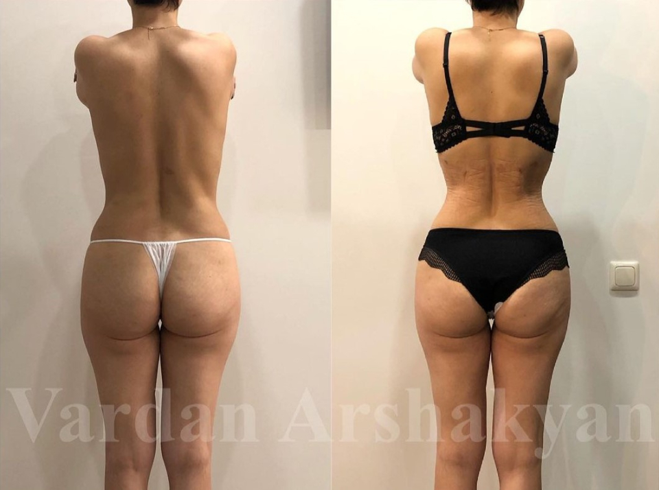 Пациентка доктора Аршакяна. Женщине выполнено хирургическое формирование узкой талии, с сохранением рёбер.