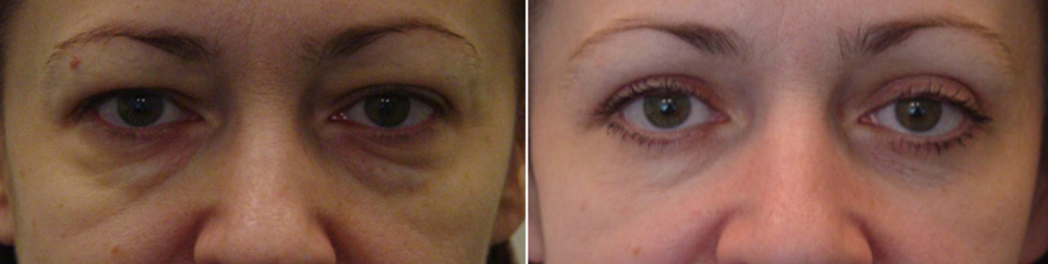 Выполнена блефаропластика верхних и нижних век с кантопексией