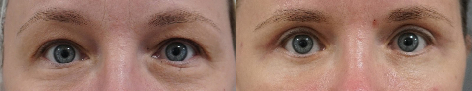 Блефаропластика верхних и нижних век. 1 месяц после операции