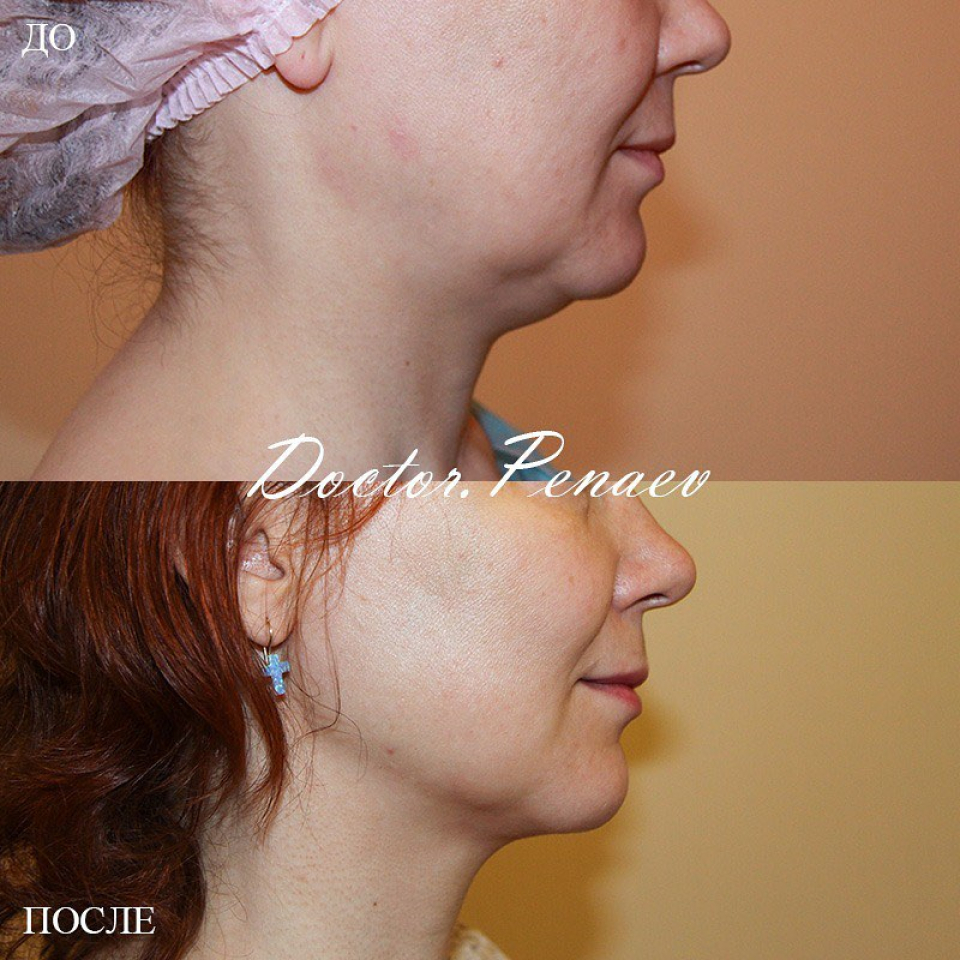 Пациентка доктора Пенаева до и после васер-липомоделирования подбородка