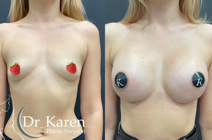Пациентка пластического хирурга Карена Пайтяна до и после увеличения груди