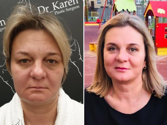 Пациентка пластического хирурга Карена Пайтяна до и после СМАС-лифтинга и блефаропластики