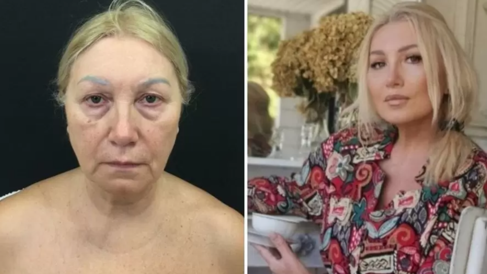 Марина Логинова до и после омолаживающей операции