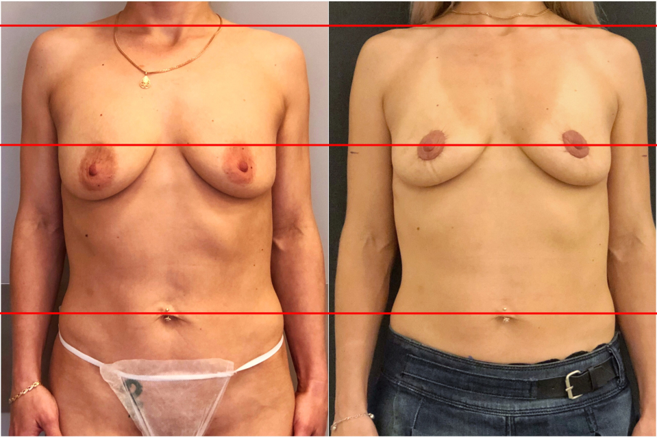 Пациентка доктора Вардана Аршакяна до и после радиочастотной подтяжки груди Breast Tite