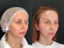Пациентка до и после показательной эндоподтяжки лба у доктора В. Аршакяна