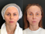 Пациентка до и после показательной эндоподтяжки лба у доктора Аршакяна