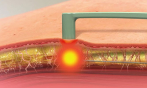 Радиочастотная липосакция Боди тайт