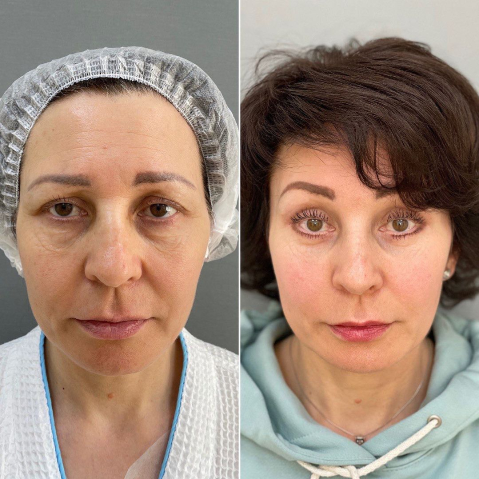 Пациентка доктора Четвериковой до и после периорбитопластики