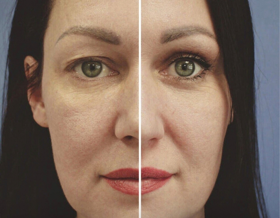 до и после блефаропластики