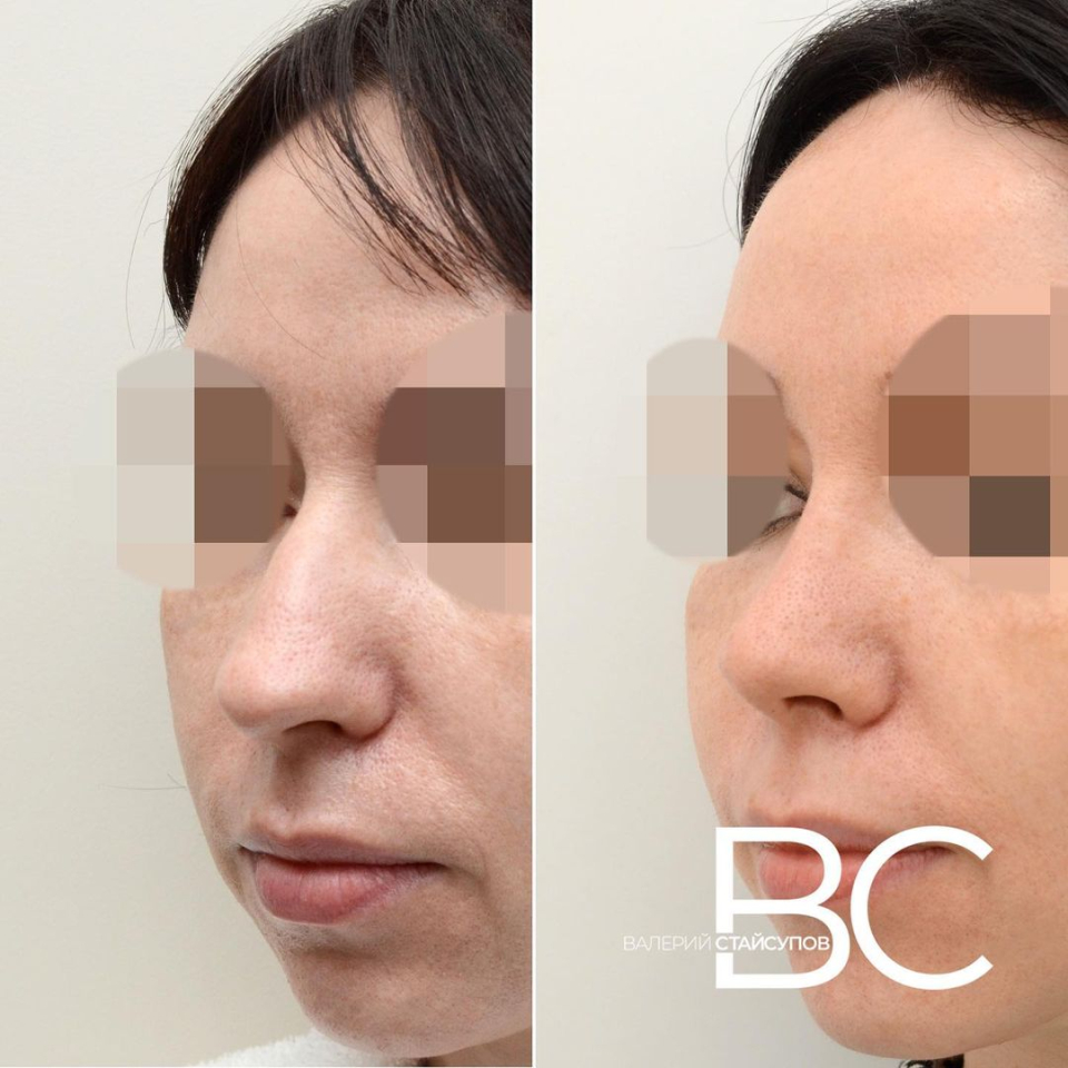 Пациентка доктора Стайсупова до и после закрытой ринопластики