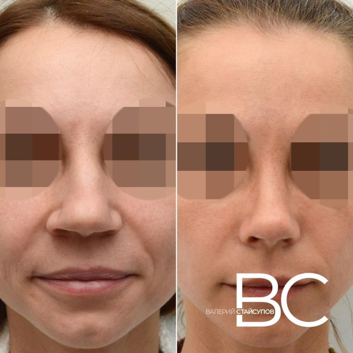 Пациентка хирурга Валерия Стайсупова до и после закрытой ринопластики носа с толстой кожей