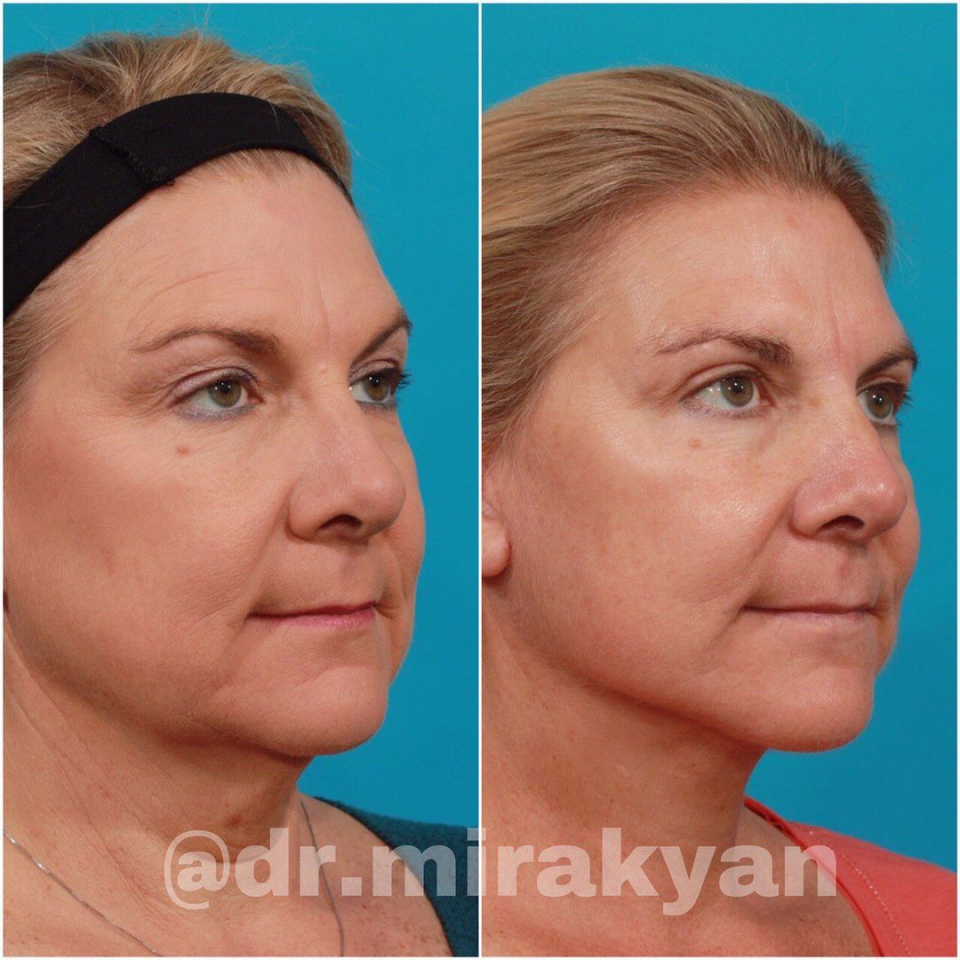 Пациентка доктора Миракяна до и после СМАС-лифтинга лица