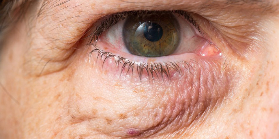 уставший взгляд блефаропластика