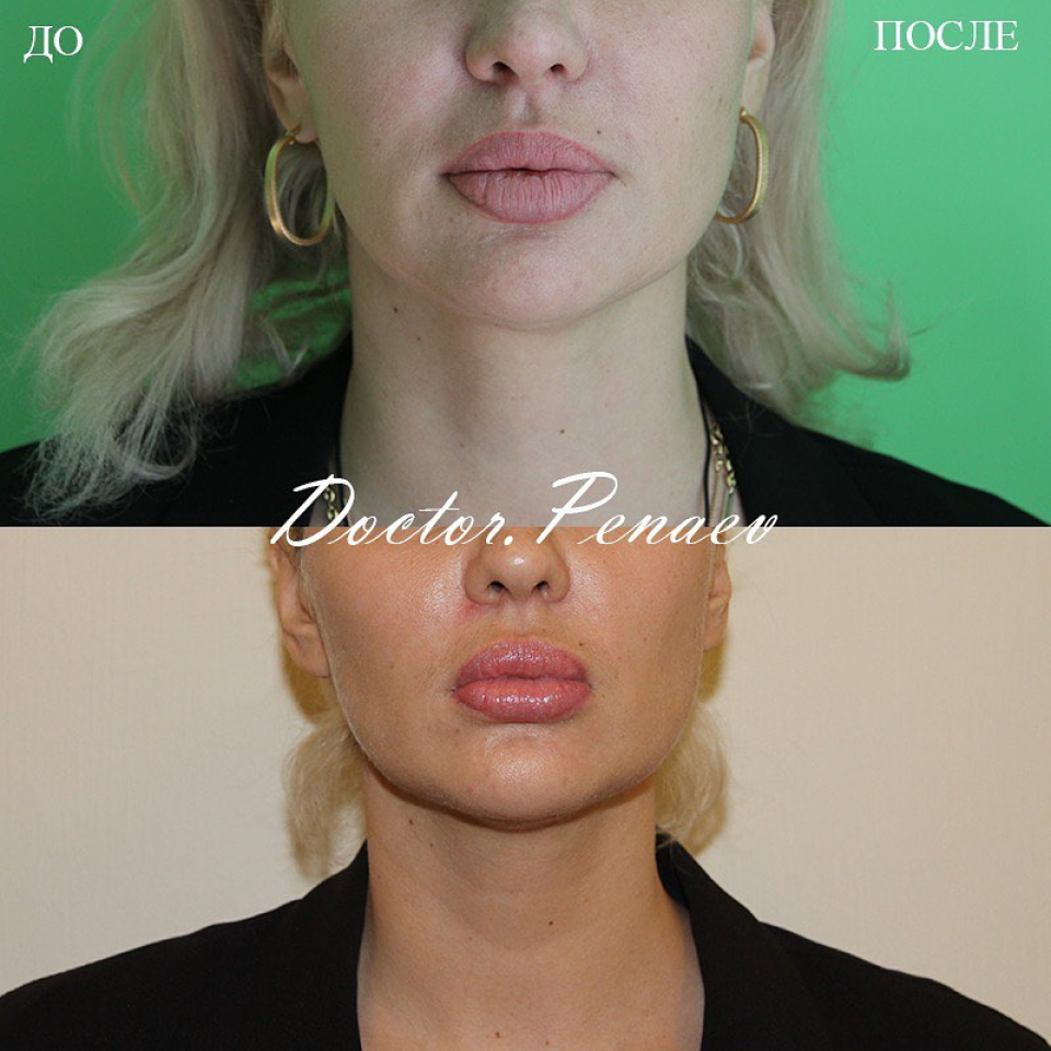 Пациентка пластического хирурга Арслана Пенаева до и после омоложения
