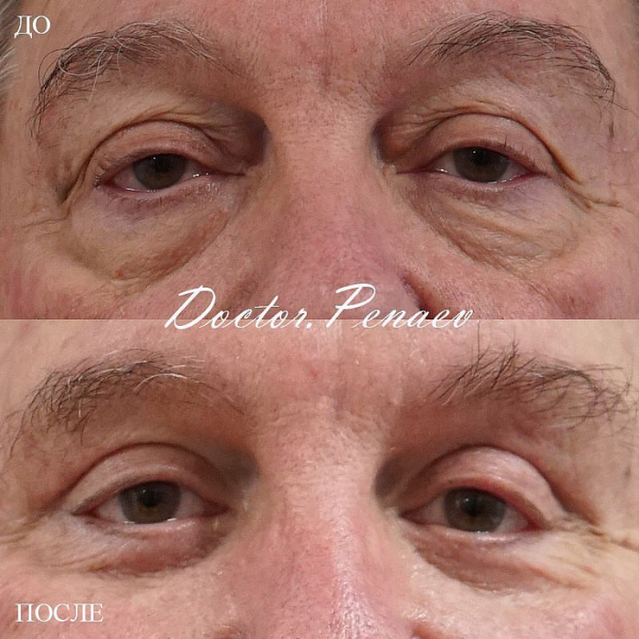Пациент доктора Пенаева до и после блефаропластики