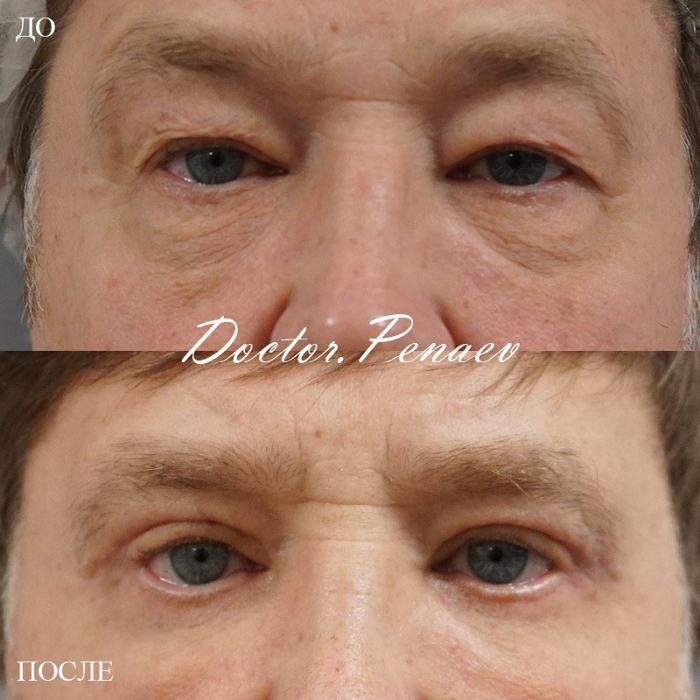 Пациент доктора Пенаева до и после мужской блефаропластики