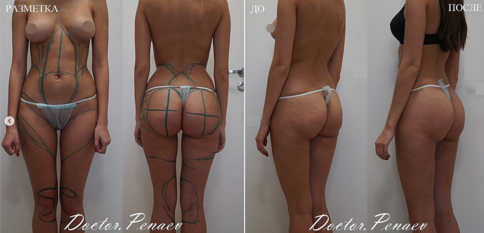 Пациентка доктора Арслана Пенаева до и после моделирования тела