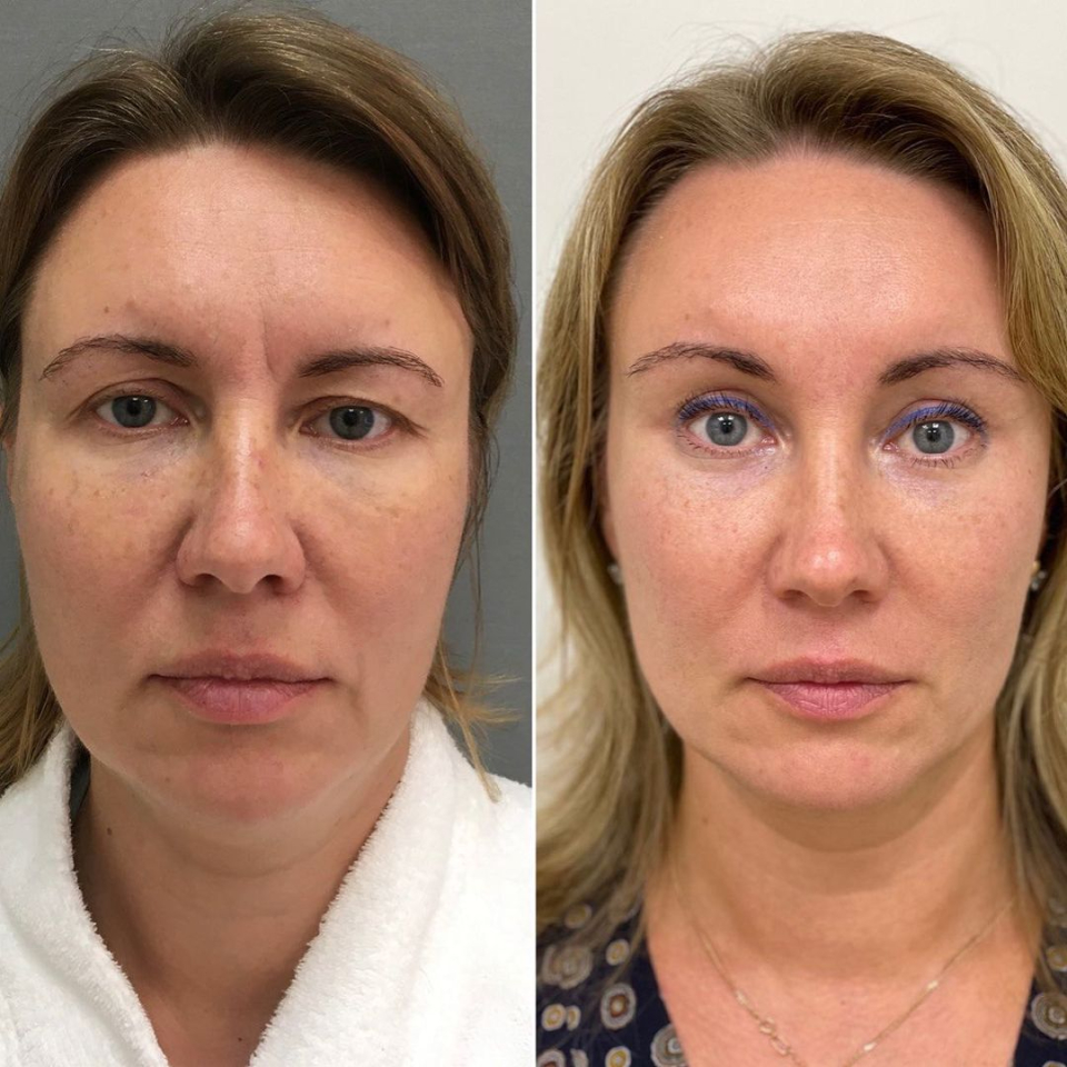 Пациентка пластического хирурга Марины Четвериковой.