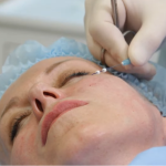 Нитевой лифтинг лица у доктора Груздева