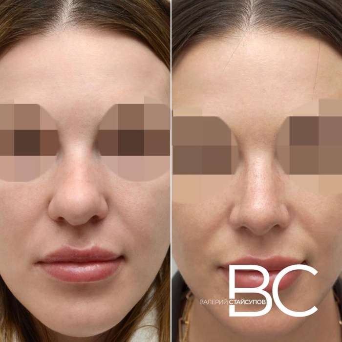 Пациентка хирурга Валерия Стайсупова до и после закрытой ринопластики носа с толстой кожей