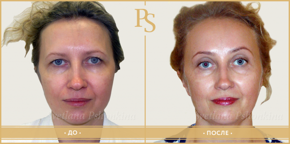 Пациентка доктора Пшонкина до и после эндоскопической подтяжки лица