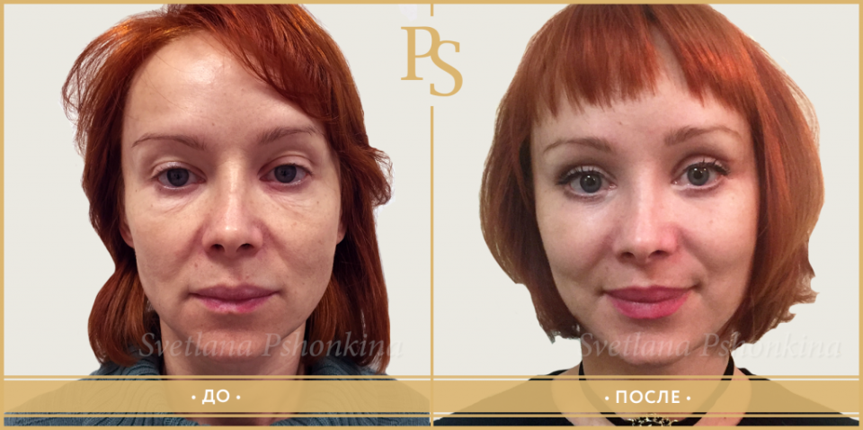 Пациентка доктора Пшонкиной до и после подтяжки лица и век