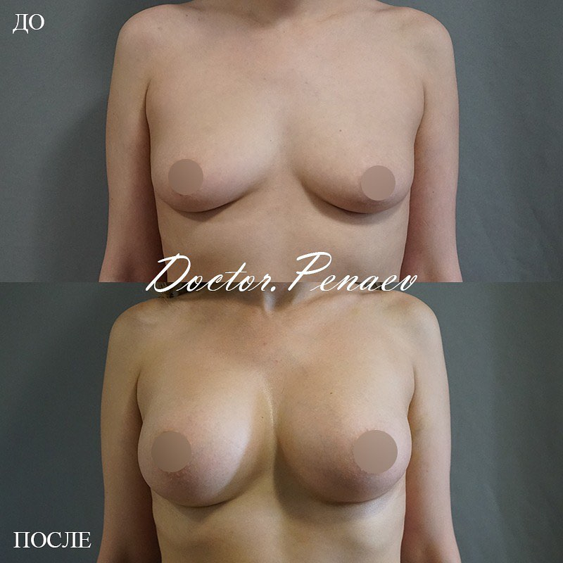 Пациентка доктора Пенаева до и после увеличения груди