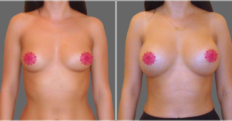 Пациентка доктора Д.А. Рябцева до и после увеличения груди
