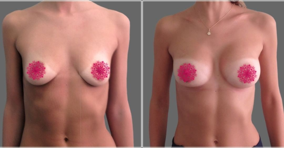 увеличение груди Дмитрий Рябцев