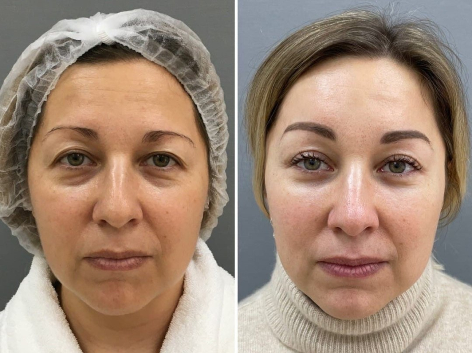 Пациентка доктора Четвериковой до и после омоложения лица