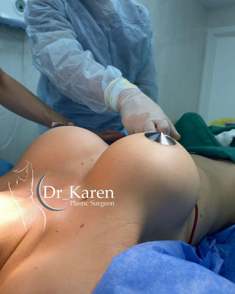 Пациентка доктора Карена Пайтяна после маммопластики