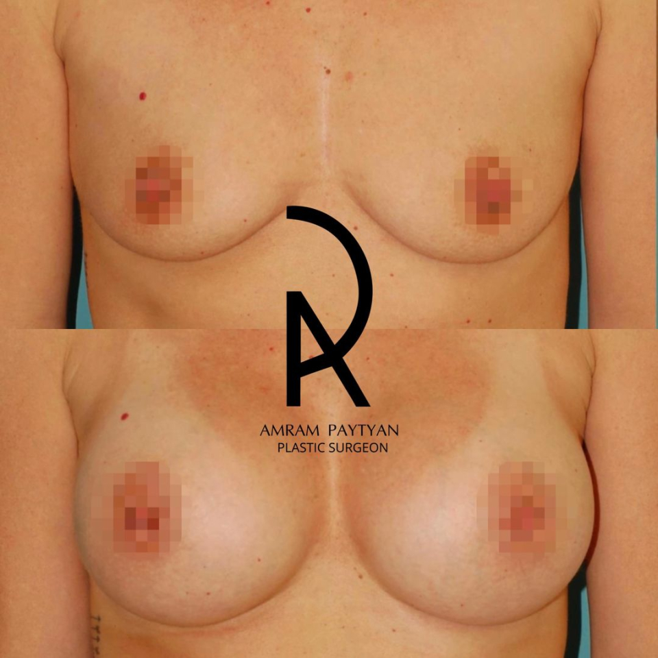 Пациентка доктора Амрама Пайтяна до и после увеличения груди