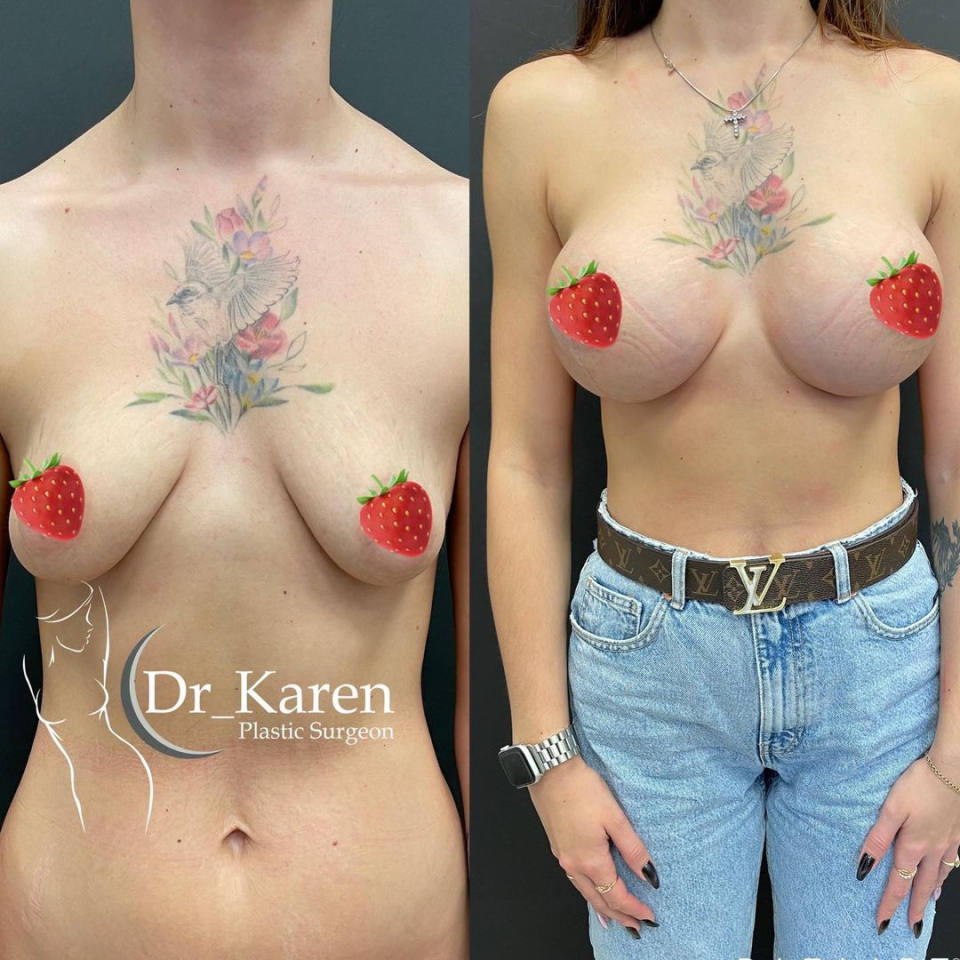 Пациентка пластического хирурга Карена Пайтяна до и после увеличения груди с подтяжкой