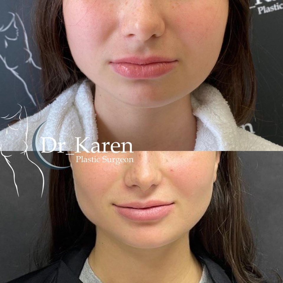 Пациентка пластического хирурга Карена Пайтяна до и после пластики нижней части лица.