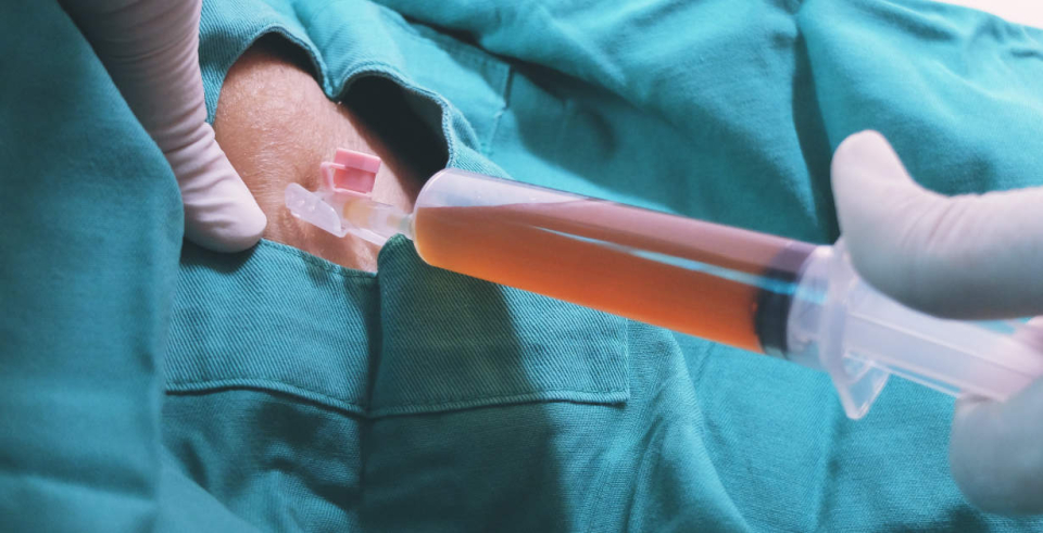 серома абдоминопластика