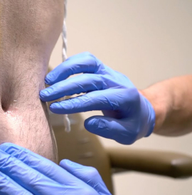 серома после абдоминопластики