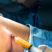 Почему не приживается жир при липофилинге?