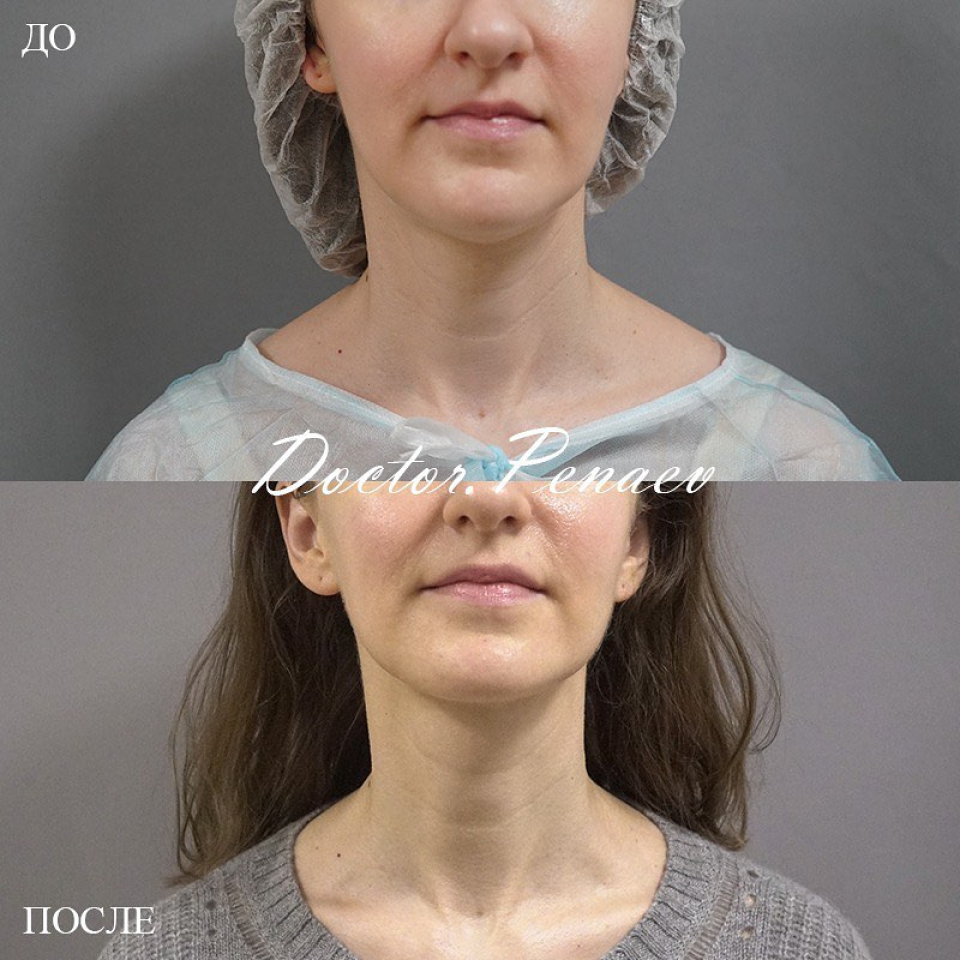 Пациентка пластического хирурга Арслана Пенаева до и после омоложения