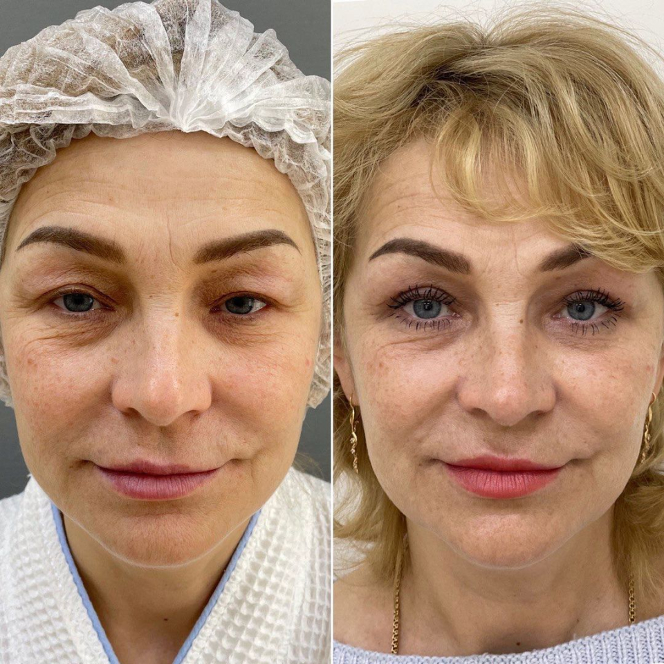 Пациентка пластического хирурга Марины Четвериковой до и после верхней блефаропластики