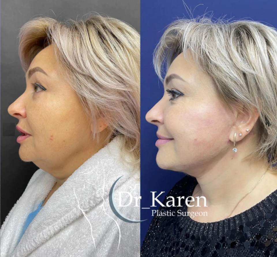 Пациентка пластического хирурга Карена Пайтяна до и после блефаропластики и подтяжки лица.