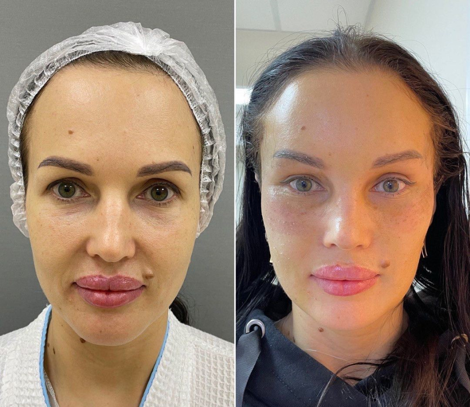 Пациентка доктора Марины Четвериковой до и после омоложения