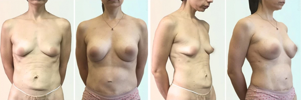 Пластический хирург Дмитрий Рябцев. Послеродовая коррекция груди