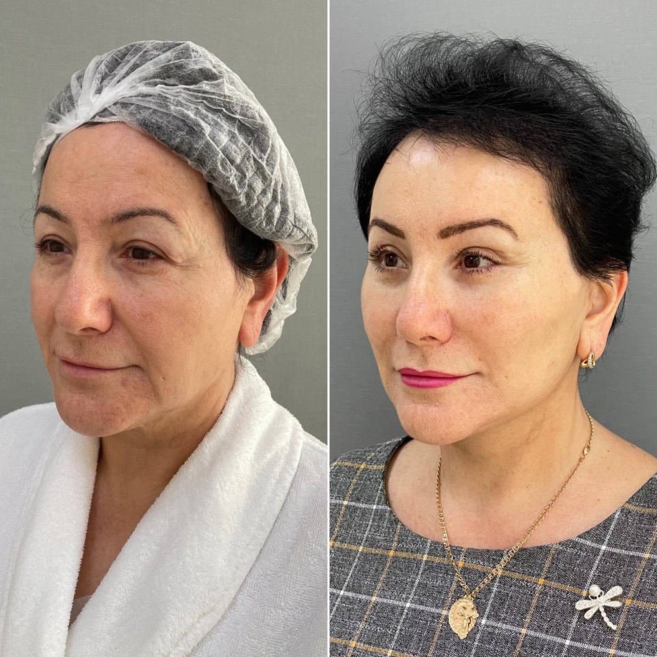 Пациентка пластического хирурга Марины Четвериковой до и после комплексного омоложения лица
