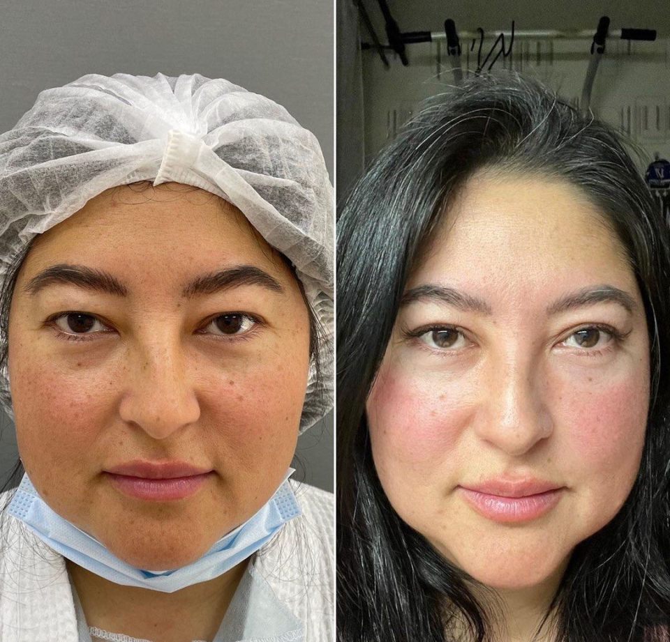 Пациентка пластического хирурга Марины Четвериковой до и после верхней блефаропластики азиатских век