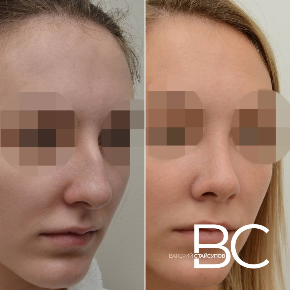 Пациентка пластического хирурга Валерия Стайсупова до и после закрытой ринопластики