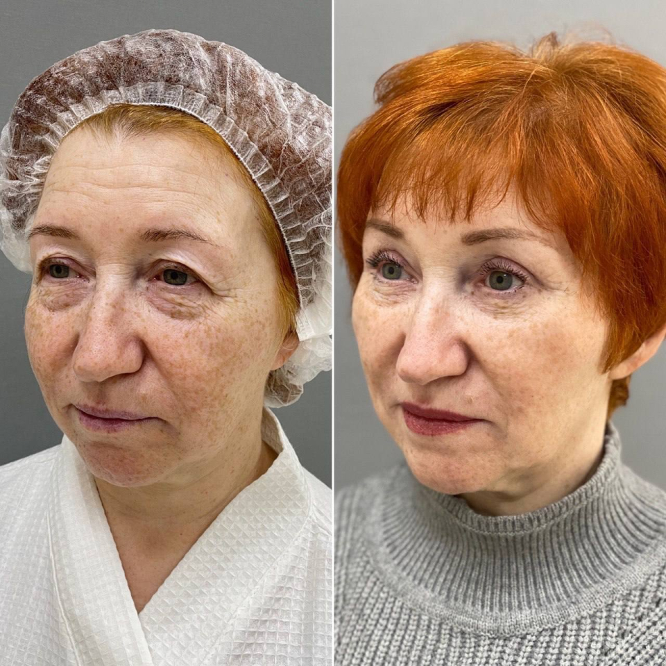 Пациентка пластического хирурга Марины Четвериковой до и после эндоскопического омоложения лица