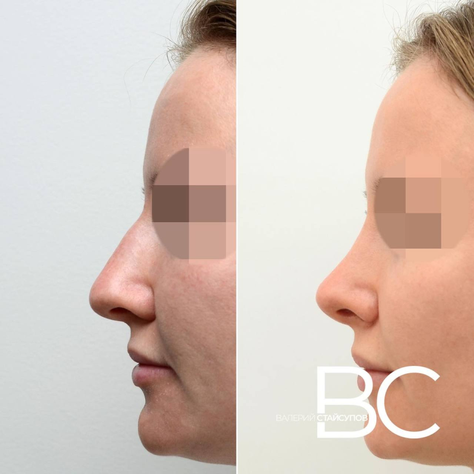 Пациентка пластического хирурга Валерия Стайсупова до и после закрытой ринопластики