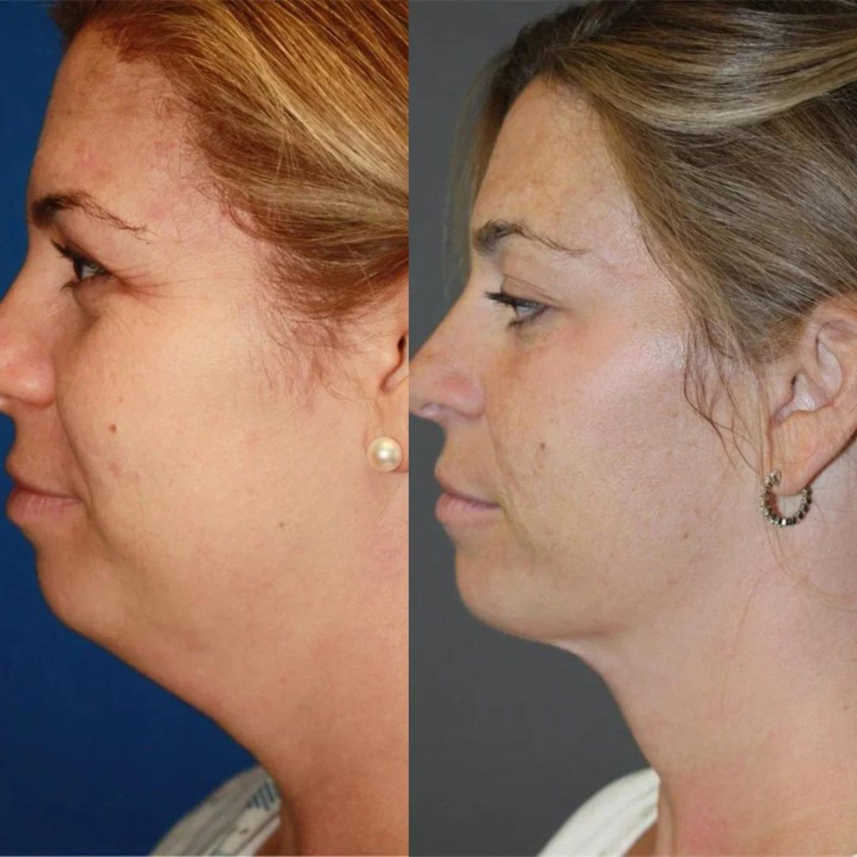 Пациентка пластического хирурга Амрама Пайтяна до и после липосакции подбородка